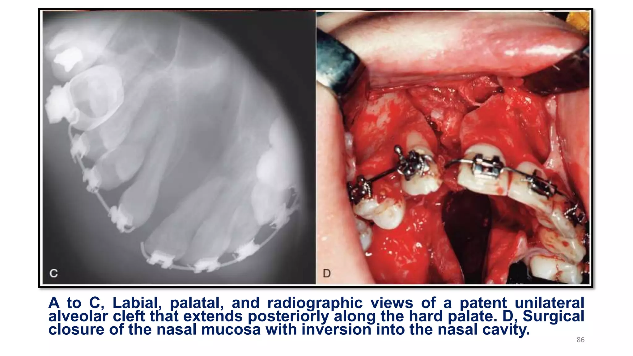 A to C, Labial, palatal, and radiographic views of a patent unilateral
alveolar cleft that extends posteriorly along the hard palate. D, Surgical
closure of the nasal mucosa with inversion into the nasal cavity. 86
 