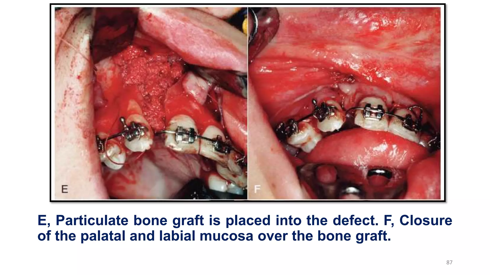 E, Particulate bone graft is placed into the defect. F, Closure
of the palatal and labial mucosa over the bone graft.
87
 