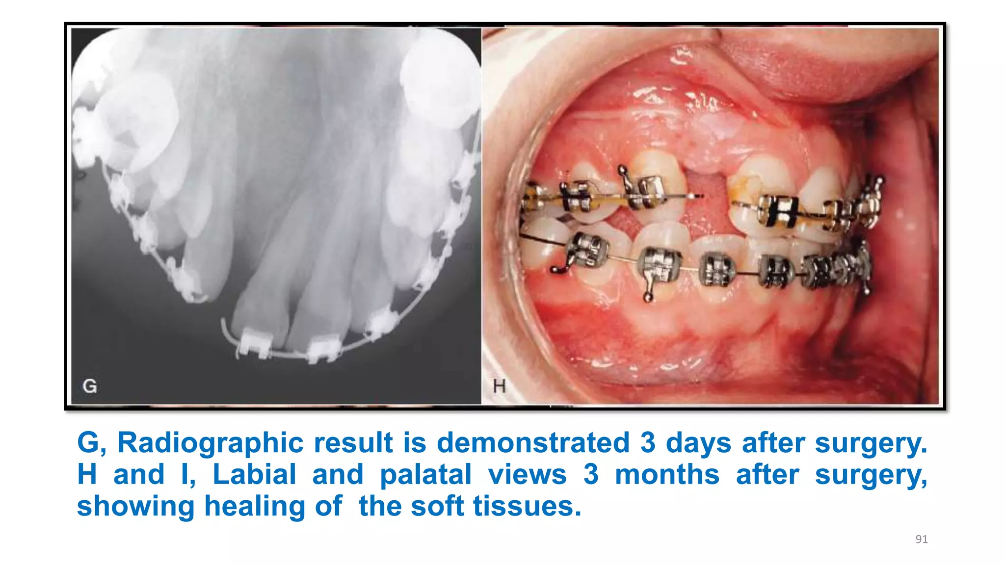 G, Radiographic result is demonstrated 3 days after surgery.
H and I, Labial and palatal views 3 months after surgery,
showing healing of the soft tissues.
91
 