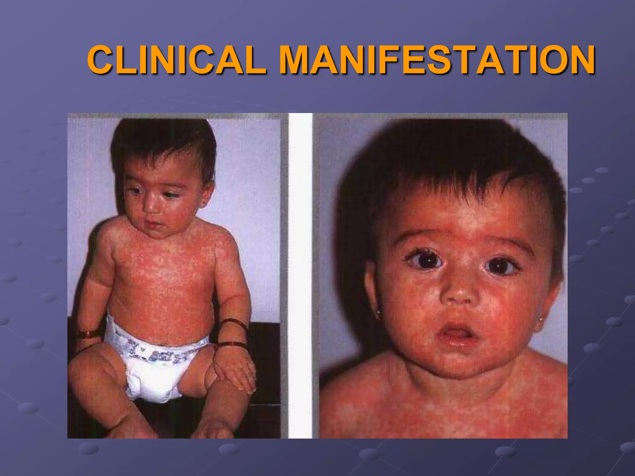 CLINICAL MANIFESTATION
 