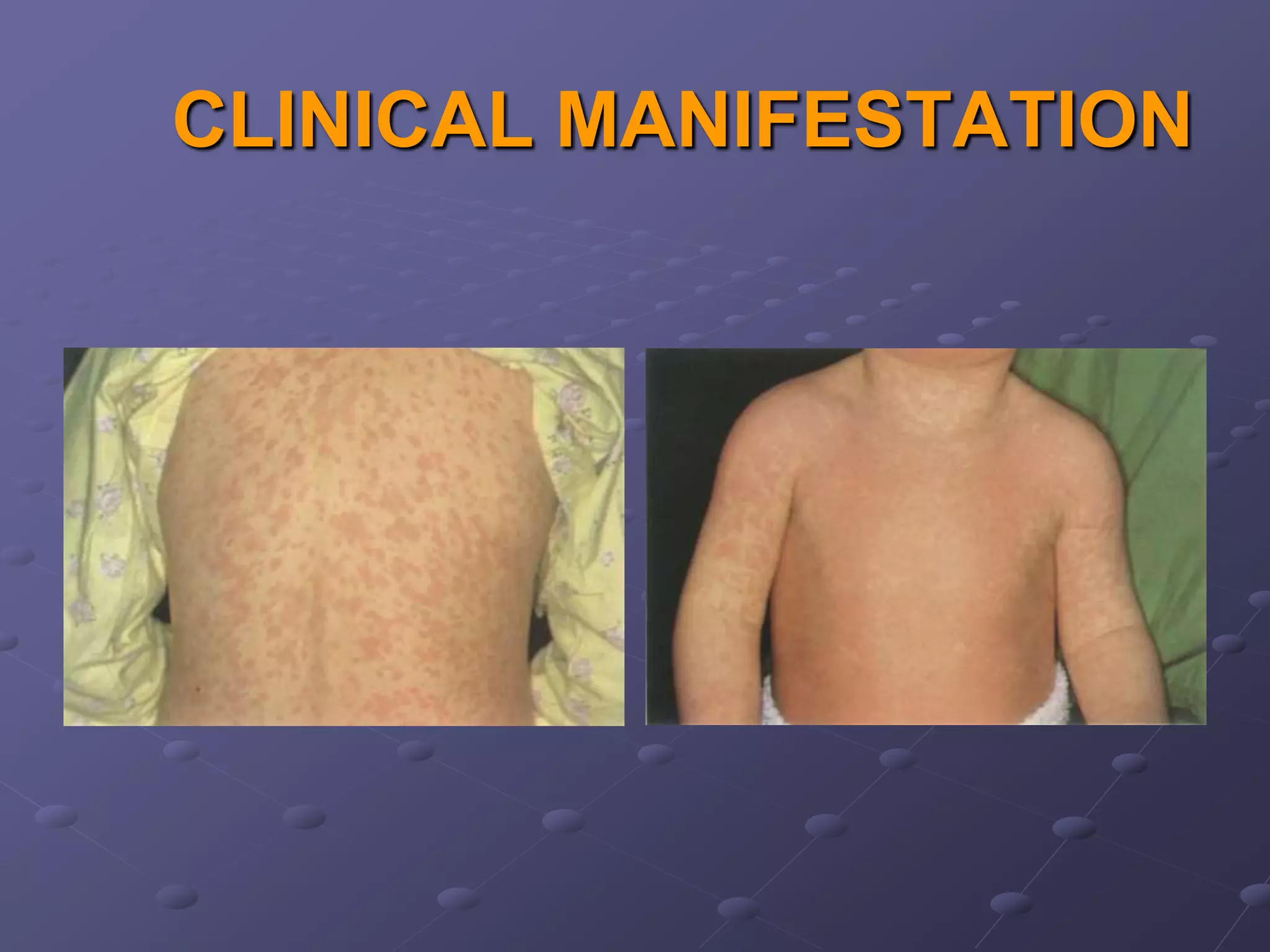 CLINICAL MANIFESTATION
 