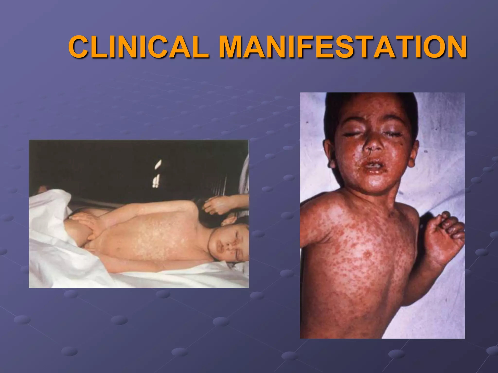 CLINICAL MANIFESTATION
 