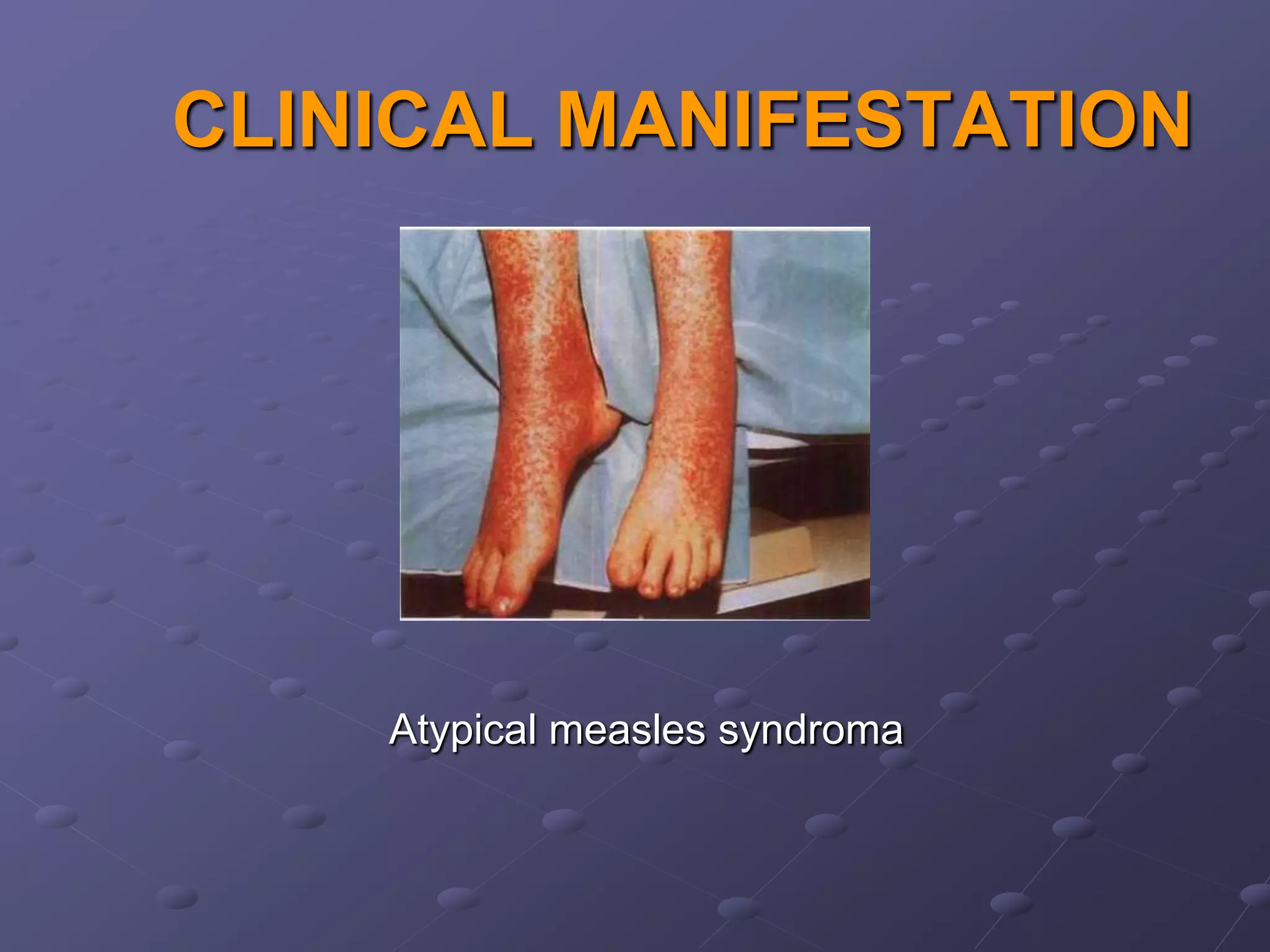 CLINICAL MANIFESTATION




    Atypical measles syndroma
 