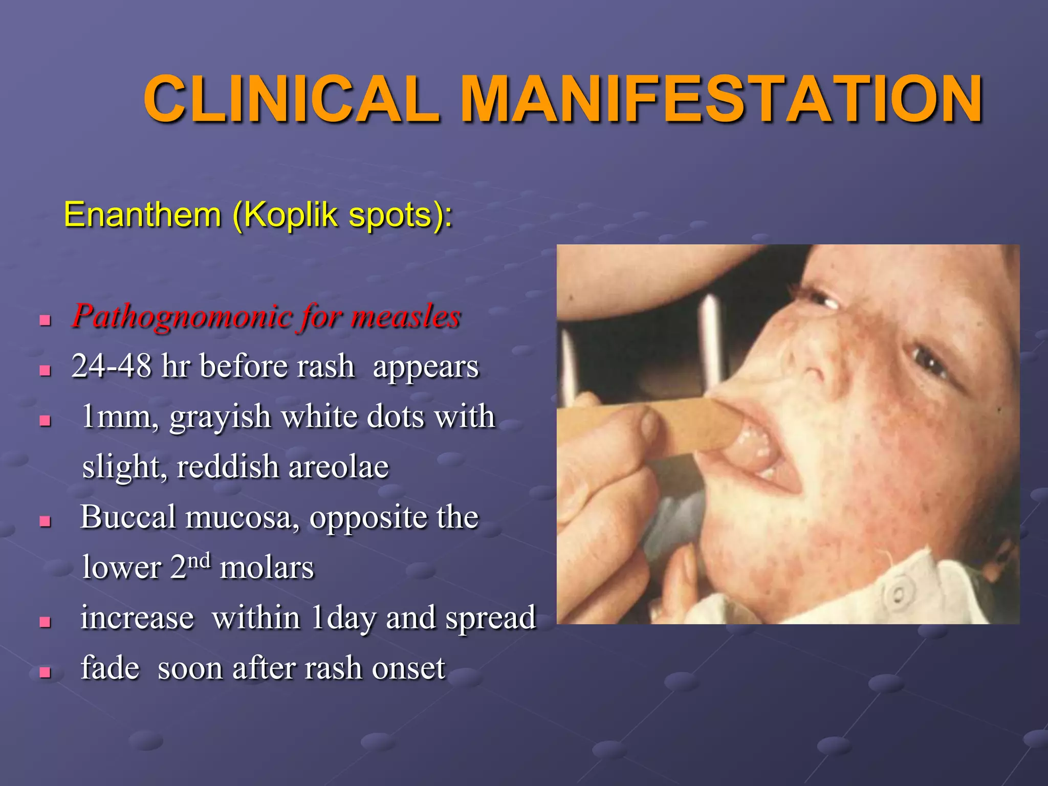 CLINICAL MANIFESTATION
    Enanthem (Koplik spots):

   Pathognomonic for measles
   24-48 hr before rash appears
   1mm, grayish white dots with
     slight, reddish areolae
   Buccal mucosa, opposite the
     lower 2nd molars
   increase within 1day and spread
   fade soon after rash onset
 