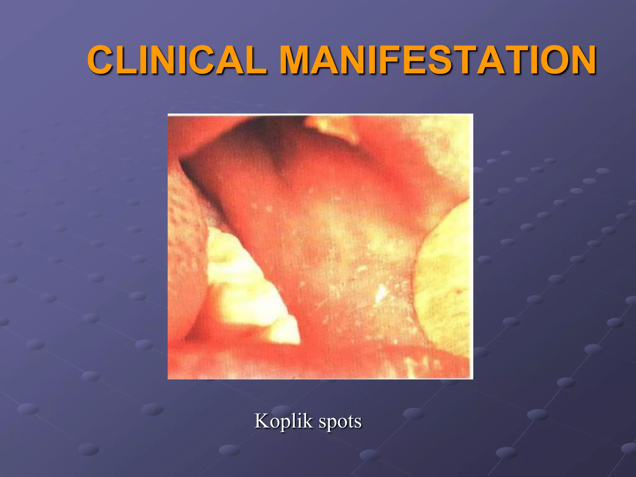 CLINICAL MANIFESTATION




       Koplik spots
 