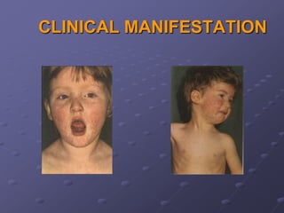 CLINICAL MANIFESTATION
 