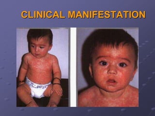CLINICAL MANIFESTATION
 
