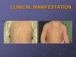 CLINICAL MANIFESTATION
 