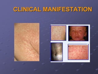 CLINICAL MANIFESTATION
 