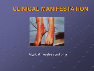 CLINICAL MANIFESTATION




    Atypical measles syndroma
 
