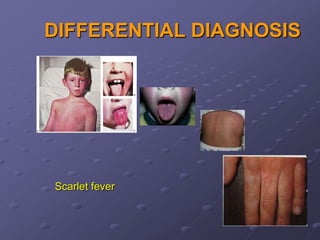 DIFFERENTIAL DIAGNOSIS




Scarlet fever
 