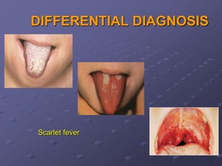 DIFFERENTIAL DIAGNOSIS




Scarlet fever
 