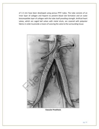 pg. 31
of 1.5 mm have been developed using porous PTFF tubes. The tube consists of an
inner layer of collagen and heparin to prevent blood clot formation and an outer
biocompatible layer of collagen with the tube itself providing strength. Artificial heart
valves, which are caged ball valves with metal struts, are covered with polyester
fabrics in order to provide a means of suturing the valve to the surrounding tissue.
Vascular Prosthesis
File
N
otC
opy
 