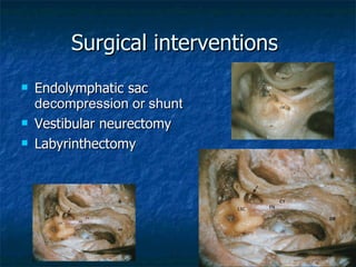Surgical interventions  Endolymphatic sac  decompression or shunt Vestibular neurectomy Labyrinthectomy 