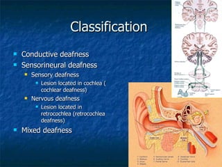 Classification  Conductive deafness Sensorineural deafness Sensory deafness  Lesion located in cochlea ( cochlear deafness) Nervous deafness Lesion located in retrocochlea (retrocochlea deafness) Mixed deafness 