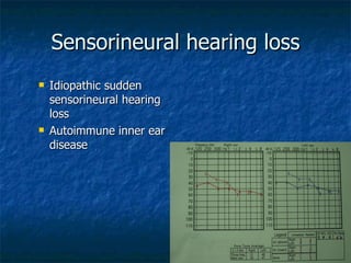 Sensorineural hearing loss Idiopathic sudden sensorineural hearing loss Autoimmune inner ear disease 