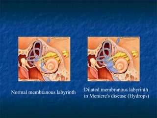 Normal membranous labyrinth  Dilated membranous labyrinth in Meniere's disease (Hydrops)  