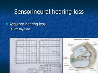 Sensorineural hearing loss Acquired hearing loss Presbycusis 