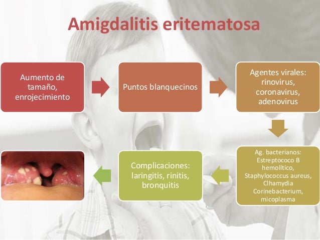 faringoamigdalitis - pediatria