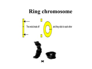 Ring chromosome
 
