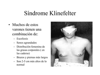 Síndrome Klinefelter
• Muchos de estos
varones tienen una
combinación de:
– Escoliosis
– Senos agrandados
– Distribución femenina de
las grasas corporales ( en
las caderas)
– Brazos y piernas más largos
– Son 2-5 cm más altos de lo
normal
 