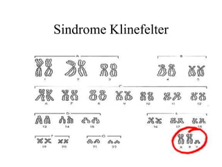 Sindrome Klinefelter
 