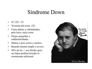 Síndrome Down
• 47, XY, +21
• Trisomía del crom. #21.
• Caras planas y redondeadas,
pelo lacio, nariz corta
• Orejas pequeñas y
subdesarrolladas
• Manos y pies cortos y anchos.
• Retardo mental simple a severo.
• 50% de las ♀ son fértiles pero
sus hijos podrían heredar el
cromosoma adicional.
 
