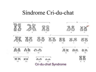 Síndrome Cri-du-chat
 