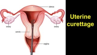 Uterus inversion and how to fix it back
 