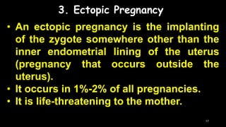 Postpartum Hemorrhage (PPH) and Ectopic Pregnancy Slide 17
