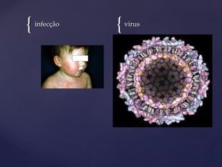 { {infecção virus
 