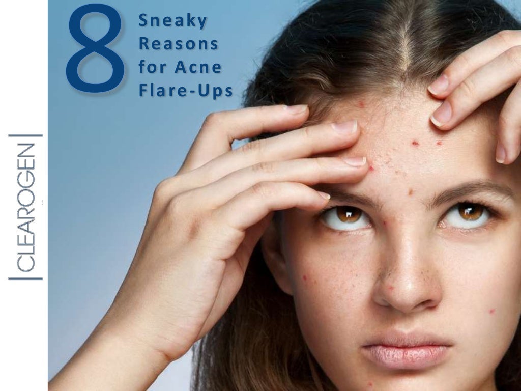 8 Sneaky Reasons for Acne Flareups