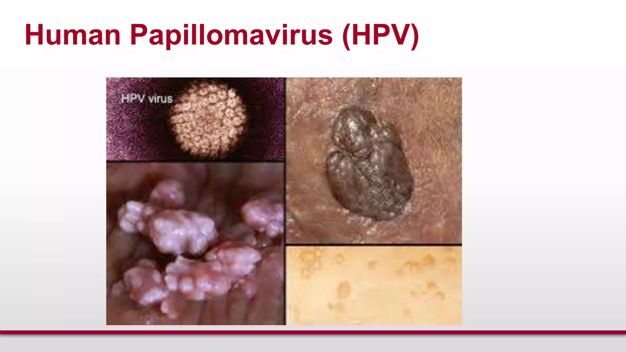 Human Papillomavirus (HPV)
 