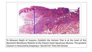 To Measure Depth of Invasion, Establish the Horizon That Is at the Level of the
Basement Membrane Relative to the Closest Intact Squamous Mucosa. The greatest
invasion is measured by dropping a “plumb line” from the horizon
 
