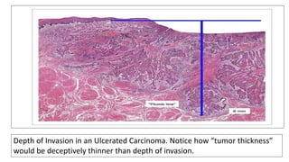 Depth of Invasion in an Ulcerated Carcinoma. Notice how “tumor thickness”
would be deceptively thinner than depth of invasion.
 