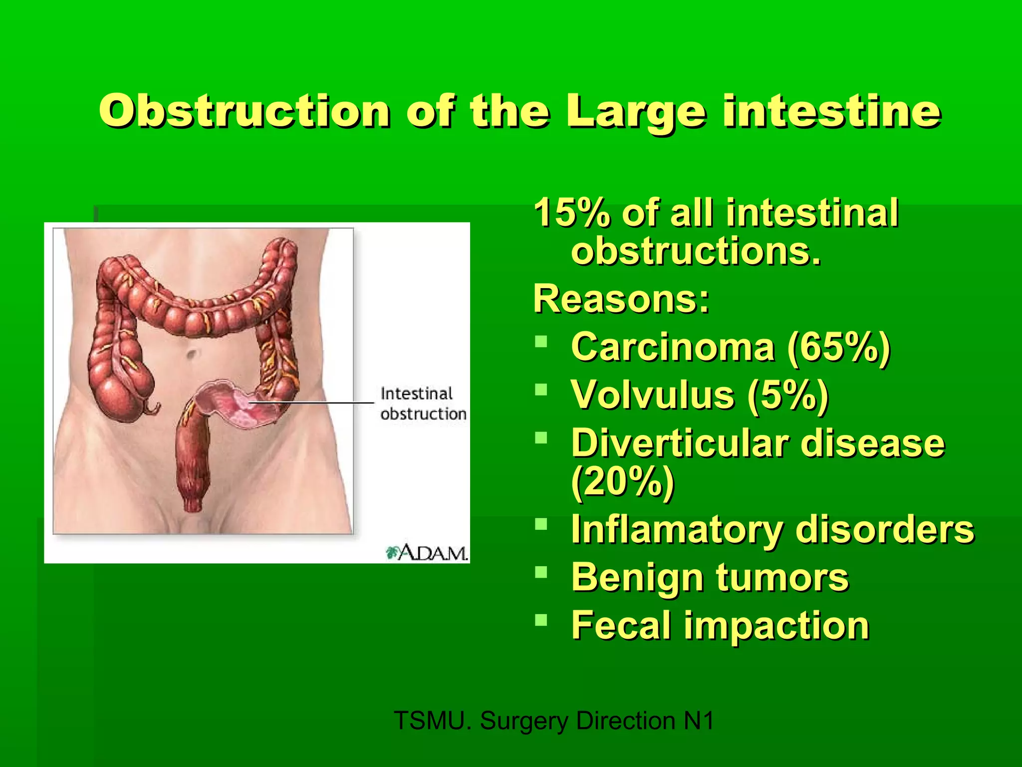 TSMU. Surgery Direction N1
Obstruction of the Large intestineObstruction of the Large intestine
15% of all intestinal15% of all intestinal
obstructions.obstructions.
Reasons:Reasons:
 Carcinoma (65%)Carcinoma (65%)
 Volvulus (5%)Volvulus (5%)
 Diverticular diseaseDiverticular disease
(20%)(20%)
 Inflamatory disordersInflamatory disorders
 Benign tumorsBenign tumors
 Fecal impactionFecal impaction
 