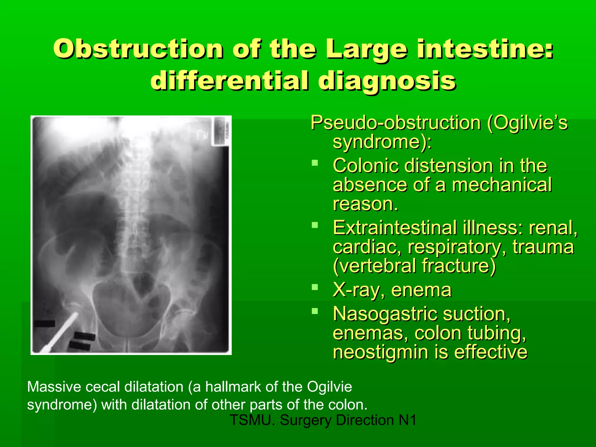 TSMU. Surgery Direction N1
Obstruction of the Large intestine:Obstruction of the Large intestine:
differential diagnosisdifferential diagnosis
Pseudo-obstruction (Ogilvie’sPseudo-obstruction (Ogilvie’s
syndrome):syndrome):
 Colonic distension in theColonic distension in the
absence of a mechanicalabsence of a mechanical
reason.reason.
 Extraintestinal illness: renal,Extraintestinal illness: renal,
cardiac, respiratory, traumacardiac, respiratory, trauma
(vertebral fracture)(vertebral fracture)
 X-ray, enemaX-ray, enema
 Nasogastric suction,Nasogastric suction,
enemas, colon tubing,enemas, colon tubing,
neostigmin is effectiveneostigmin is effective
Massive cecal dilatation (a hallmark of the Ogilvie
syndrome) with dilatation of other parts of the colon.
 