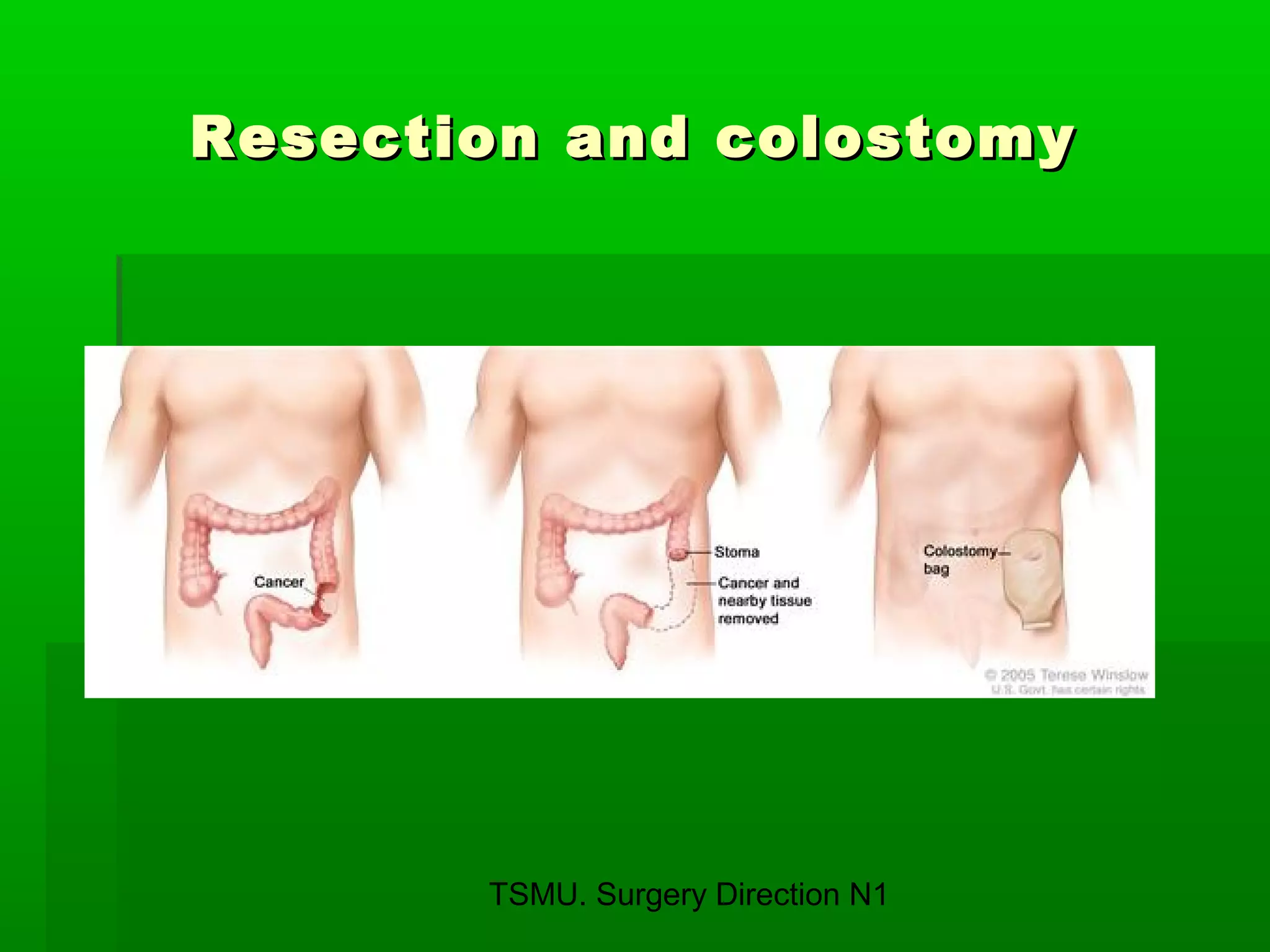 TSMU. Surgery Direction N1
Resection and colostomyResection and colostomy
 