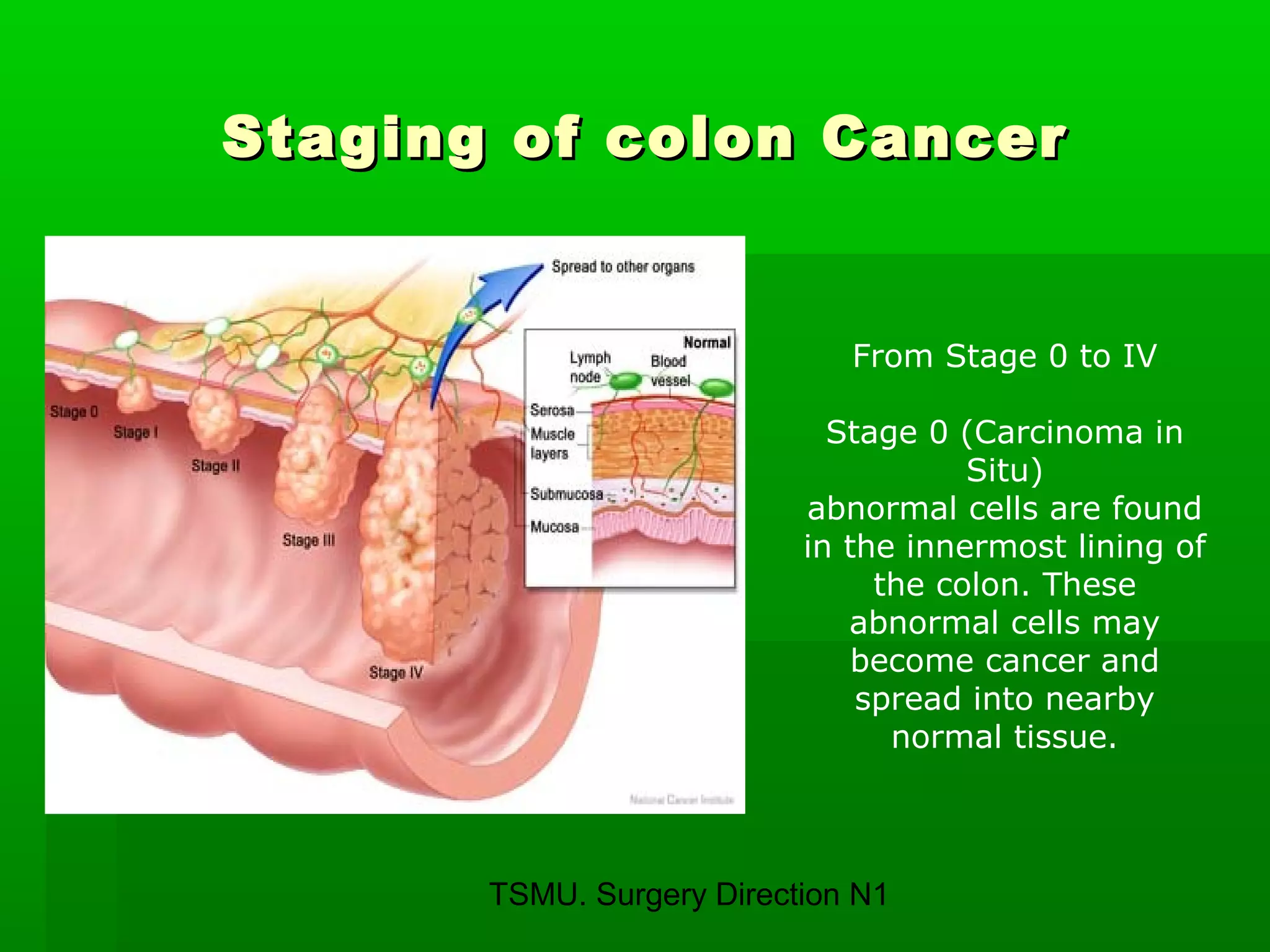 TSMU. Surgery Direction N1
Staging of colon CancerStaging of colon Cancer
From Stage 0 to IV
Stage 0 (Carcinoma in
Situ)
abnormal cells are found
in the innermost lining of
the colon. These
abnormal cells may
become cancer and
spread into nearby
normal tissue.
 