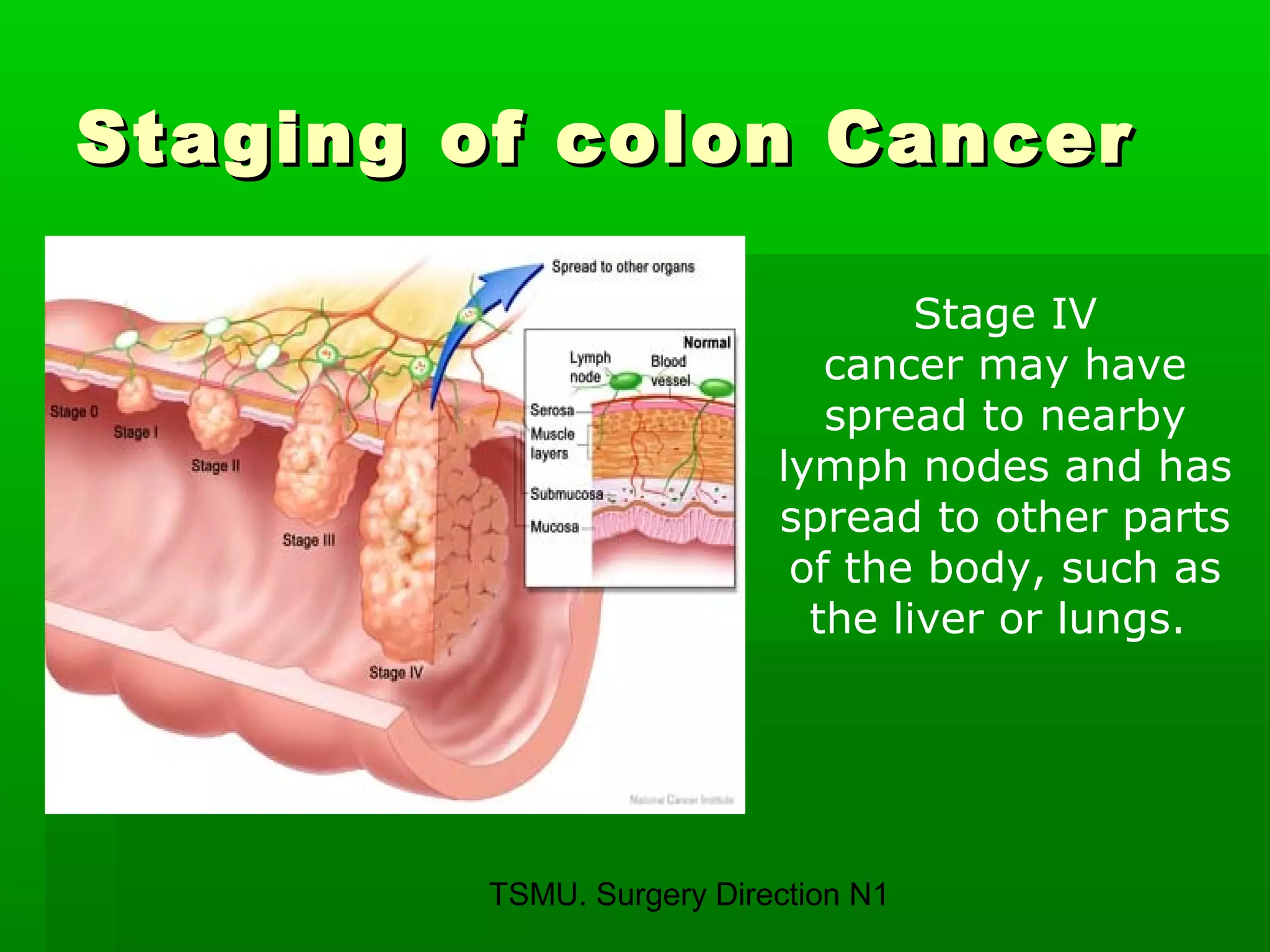 TSMU. Surgery Direction N1
Staging of colon CancerStaging of colon Cancer
Stage IV
cancer may have
spread to nearby
lymph nodes and has
spread to other parts
of the body, such as
the liver or lungs.
 
