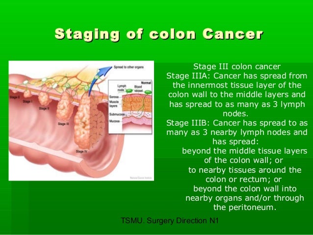 Colon cancer stage 2b