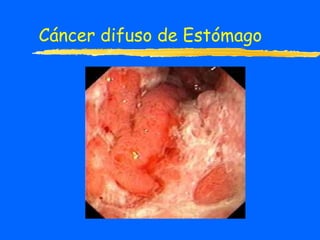 Cáncer difuso de Estómago 