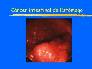 Cáncer intestinal de Estómago 