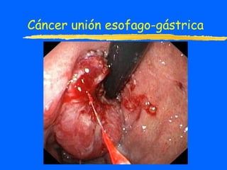 Cáncer unión esofago-gástrica 