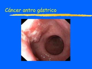 Cáncer antro gástrico 