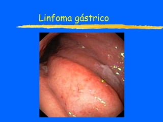 Linfoma gástrico 