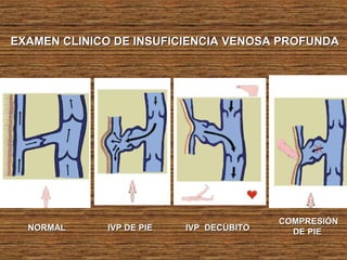 EXAMEN CLINICO DE INSUFICIENCIA VENOSA PROFUNDAEXAMEN CLINICO DE INSUFICIENCIA VENOSA PROFUNDA
NORMALNORMAL IVP DE PIEIVP DE PIE IVP DECÚBITOIVP DECÚBITO
COMPRESIÓNCOMPRESIÓN
DE PIEDE PIE
 