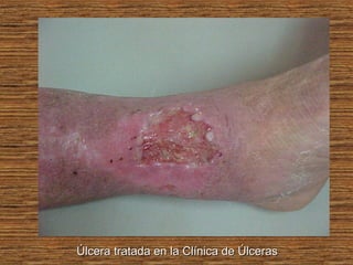 Úlcera tratada en la Clínica de ÚlcerasÚlcera tratada en la Clínica de Úlceras
 