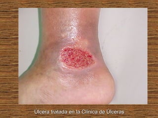 Úlcera tratada en la Clínica de ÚlcerasÚlcera tratada en la Clínica de Úlceras
 