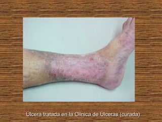 Úlcera tratada en la Clínica de Úlceras (curada)Úlcera tratada en la Clínica de Úlceras (curada)
 